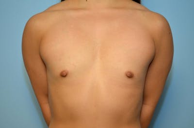 Breast Augmentation Before & After Gallery - Patient 479039 - Image 1