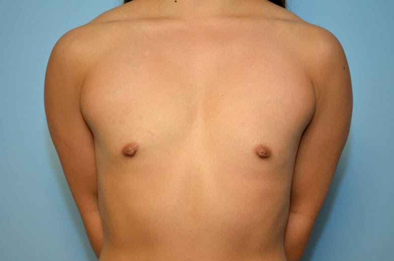 Breast Augmentation Before & After Gallery - Patient 479039 - Image 1