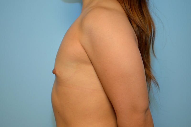 Breast Augmentation Before & After Gallery - Patient 479039 - Image 9