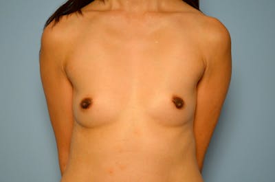 Breast Augmentation Before & After Gallery - Patient 669358 - Image 1