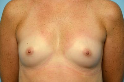 Breast Augmentation Before & After Gallery - Patient 829903 - Image 1