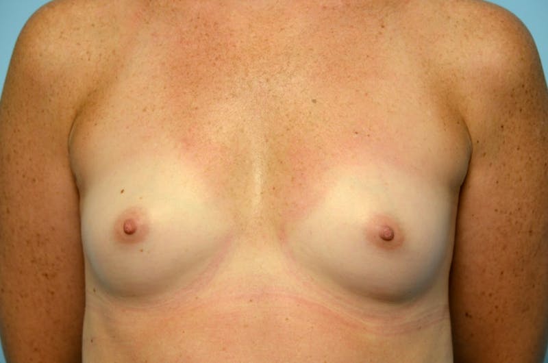 Breast Augmentation Before & After Gallery - Patient 829903 - Image 1
