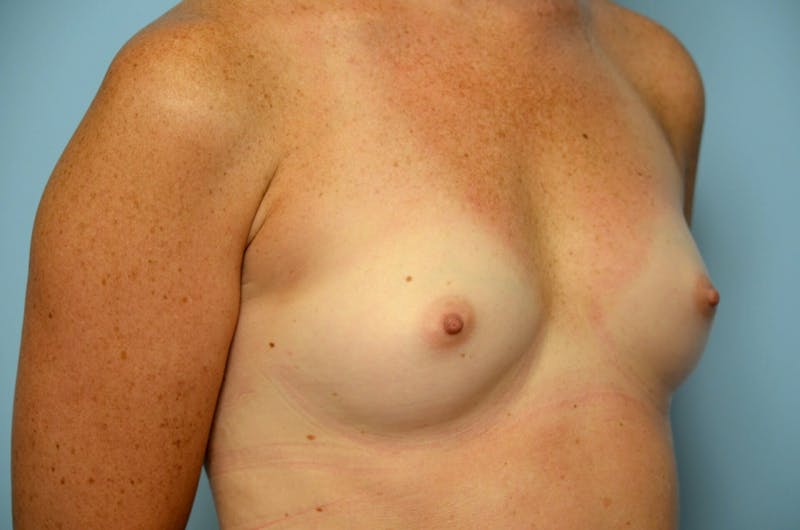 Breast Augmentation Before & After Gallery - Patient 829903 - Image 3