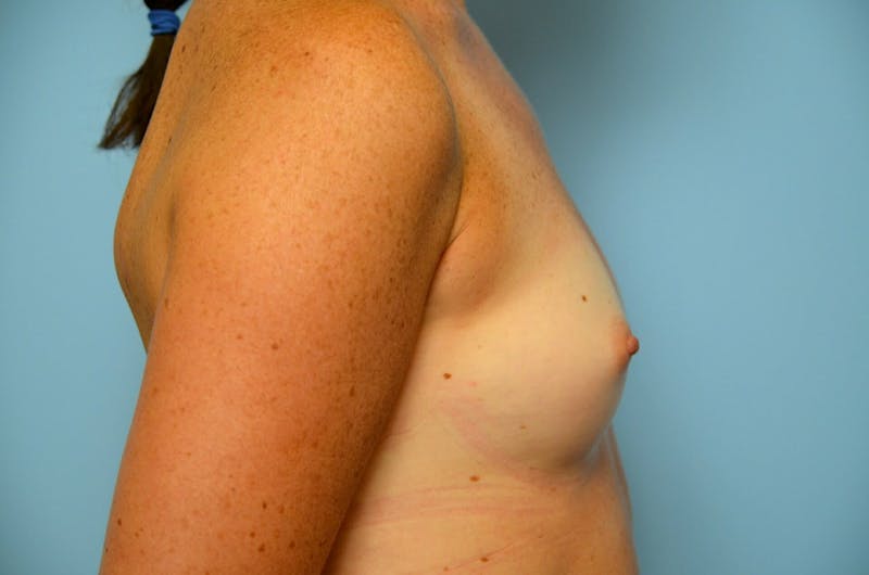 Breast Augmentation Before & After Gallery - Patient 829903 - Image 5