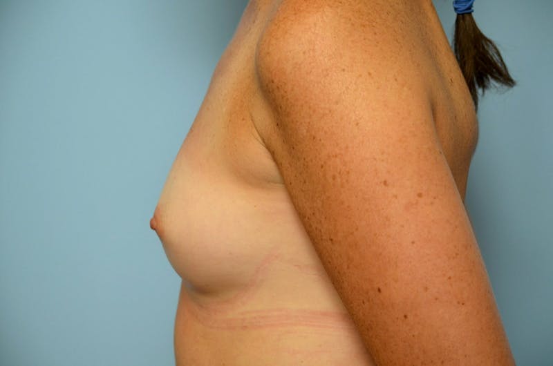 Breast Augmentation Before & After Gallery - Patient 829903 - Image 9