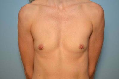 Breast Augmentation Before & After Gallery - Patient 335107 - Image 1