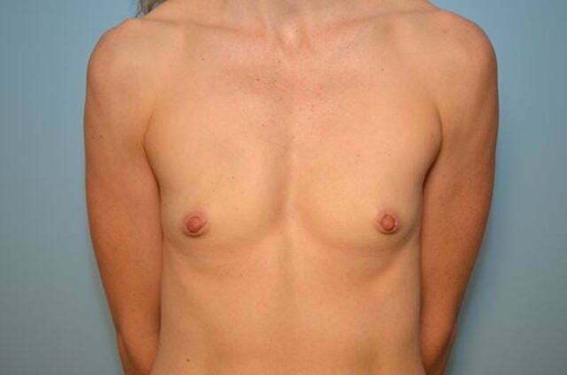 Breast Augmentation Before & After Gallery - Patient 335107 - Image 1