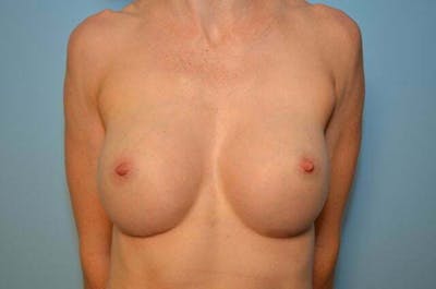 Breast Augmentation Before & After Gallery - Patient 335107 - Image 2