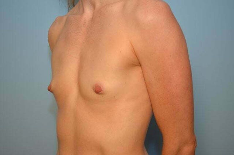 Breast Augmentation Before & After Gallery - Patient 335107 - Image 7