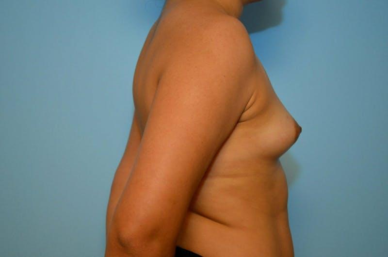 Breast Augmentation Before & After Gallery - Patient 377394 - Image 5