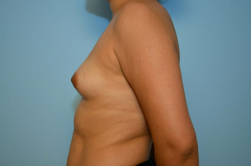 Breast Augmentation Before & After Gallery - Patient 377394 - Image 9