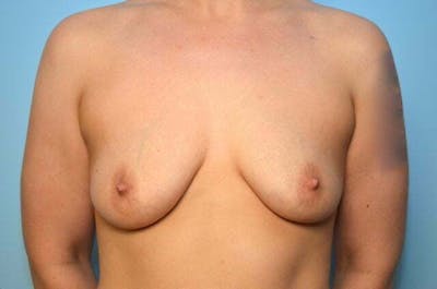 Breast Augmentation Before & After Gallery - Patient 377941 - Image 1