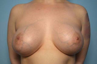 Breast Augmentation Before & After Gallery - Patient 377941 - Image 2