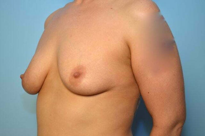 Breast Augmentation Before & After Gallery - Patient 377941 - Image 7