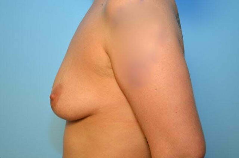 Breast Augmentation Before & After Gallery - Patient 377941 - Image 9
