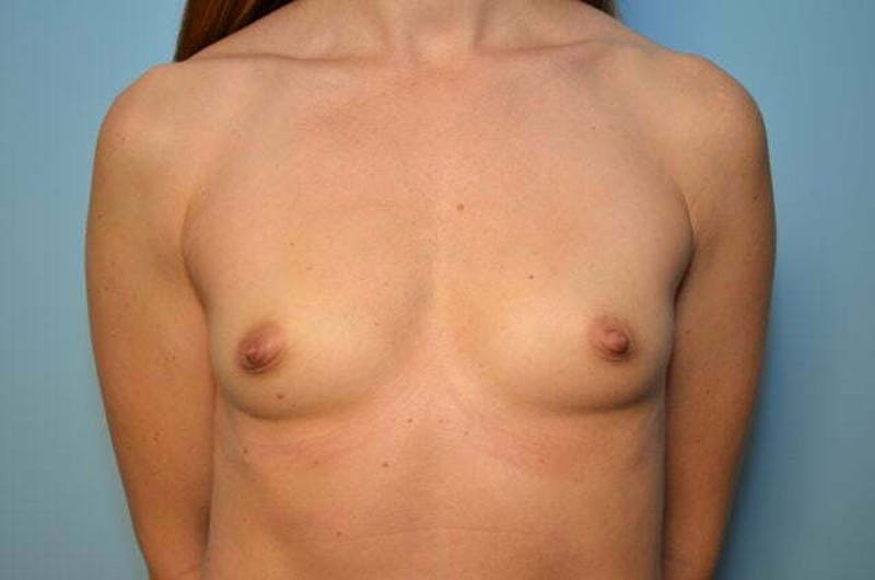 Breast Augmentation Before & After Gallery - Patient 118156 - Image 1