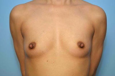 Breast Augmentation Before & After Gallery - Patient 167090 - Image 1