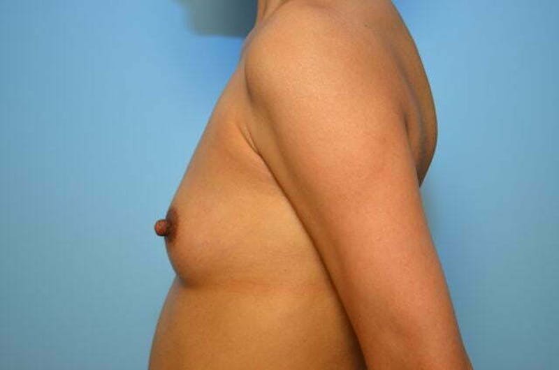 Breast Augmentation Before & After Gallery - Patient 167090 - Image 9