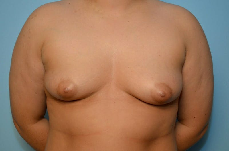 Breast Augmentation Before & After Gallery - Patient 235753 - Image 1
