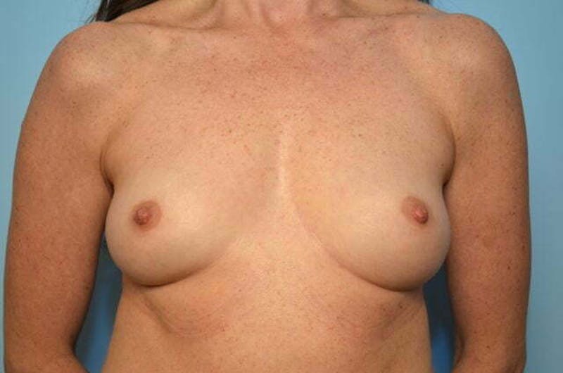 Breast Augmentation Before & After Gallery - Patient 407151 - Image 1