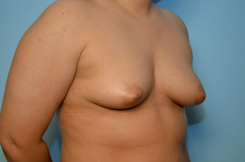 Breast Augmentation Before & After Gallery - Patient 235753 - Image 3