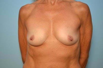 Breast Augmentation Before & After Gallery - Patient 271305 - Image 1
