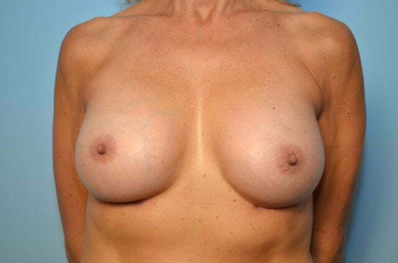Breast Augmentation Before & After Gallery - Patient 271305 - Image 2