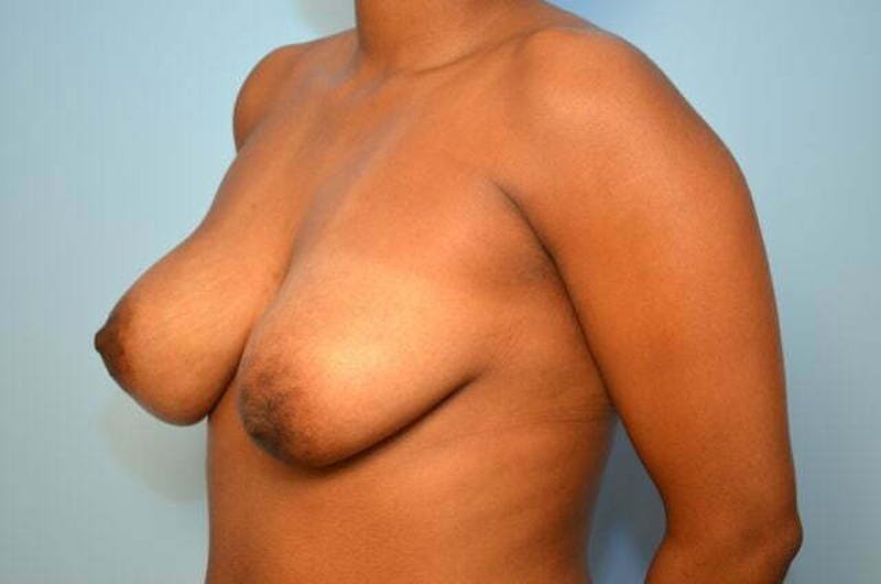 Breast Augmentation Before & After Gallery - Patient 144286 - Image 7