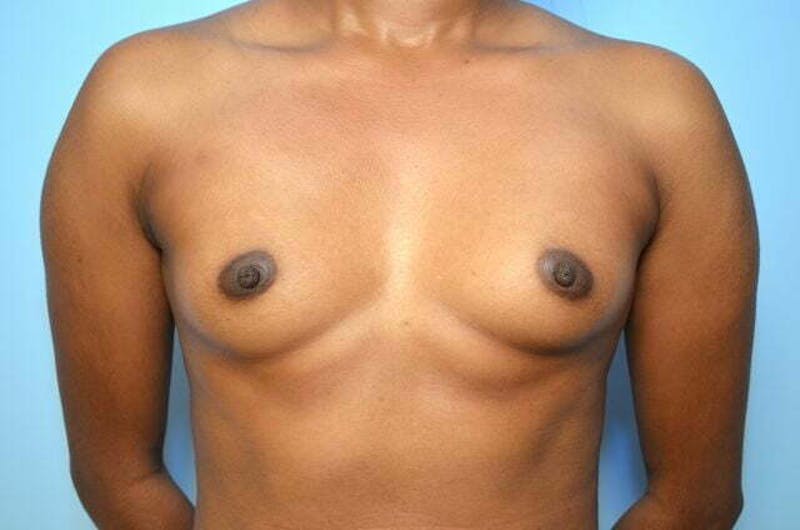 Breast Augmentation Before & After Gallery - Patient 416631 - Image 1