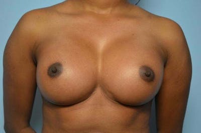 Breast Augmentation Before & After Gallery - Patient 416631 - Image 2