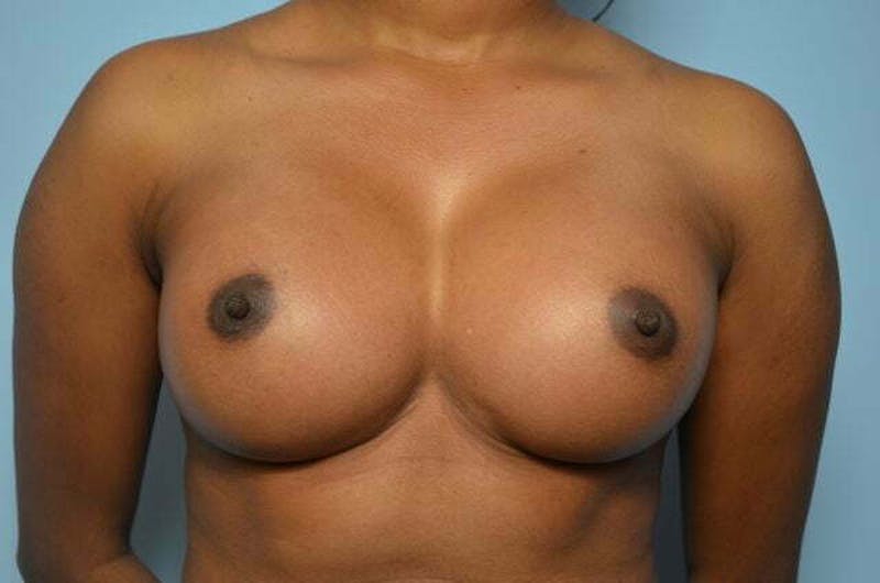 Breast Augmentation Before & After Gallery - Patient 416631 - Image 2
