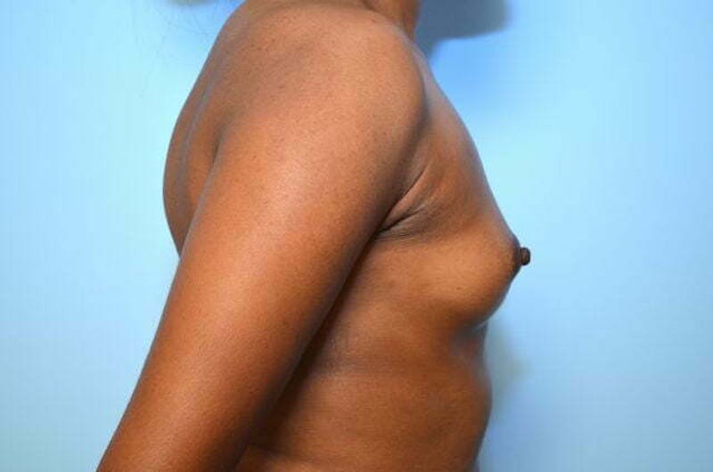 Breast Augmentation Before & After Gallery - Patient 416631 - Image 5
