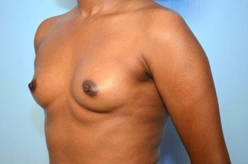 Breast Augmentation Before & After Gallery - Patient 416631 - Image 7