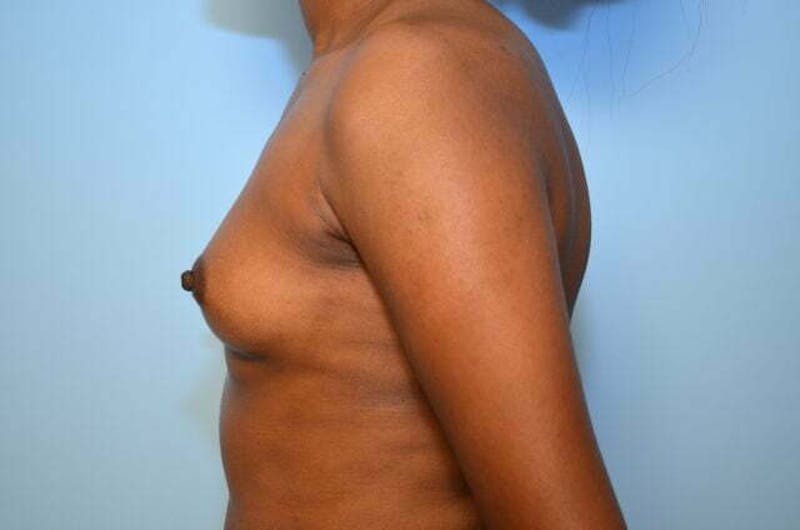 Breast Augmentation Before & After Gallery - Patient 416631 - Image 9