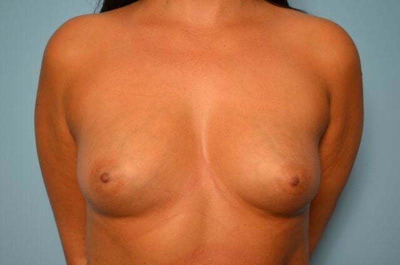 Breast Augmentation Before & After Gallery - Patient 189533 - Image 1