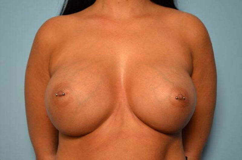 Breast Augmentation Before & After Gallery - Patient 189533 - Image 2
