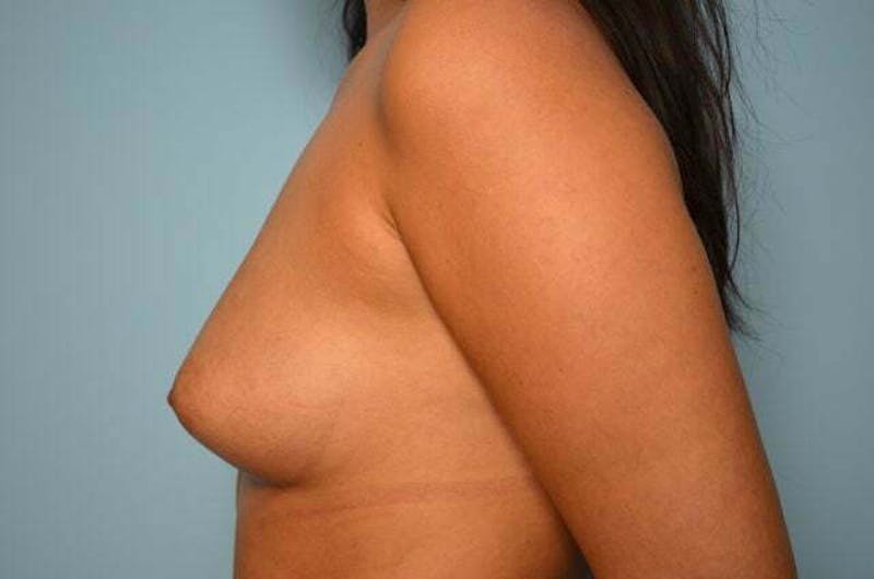Breast Augmentation Before & After Gallery - Patient 189533 - Image 9