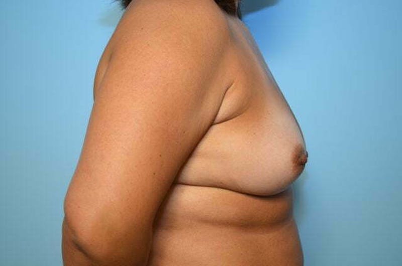 Breast Augmentation Before & After Gallery - Patient 139001 - Image 5