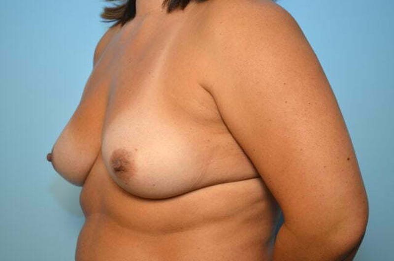 Breast Augmentation Before & After Gallery - Patient 139001 - Image 7