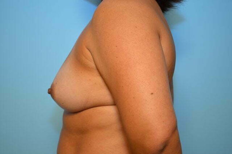 Breast Augmentation Before & After Gallery - Patient 139001 - Image 9