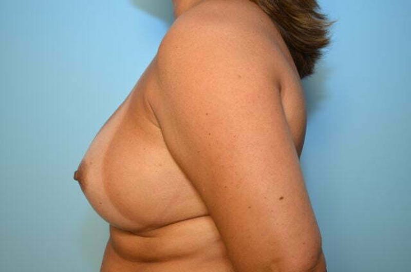Breast Augmentation Before & After Gallery - Patient 139001 - Image 10