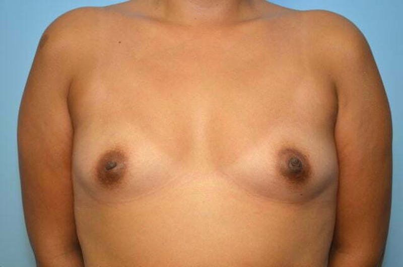 Breast Augmentation Before & After Gallery - Patient 332697 - Image 1