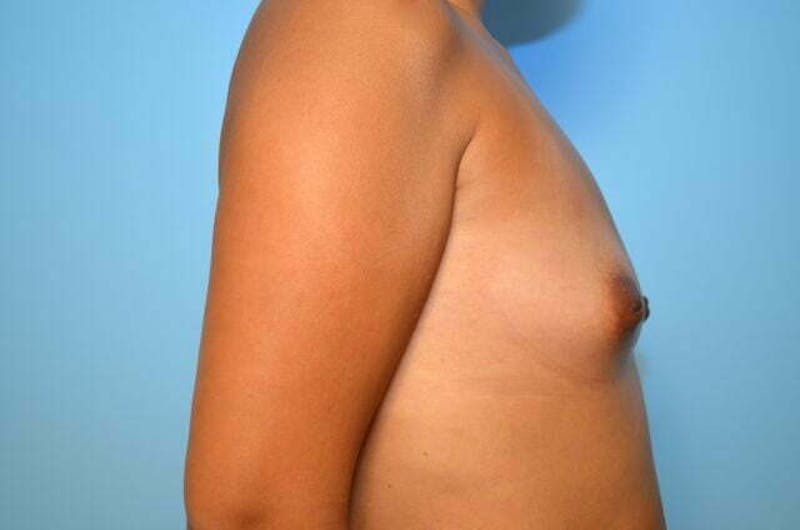 Breast Augmentation Before & After Gallery - Patient 332697 - Image 5
