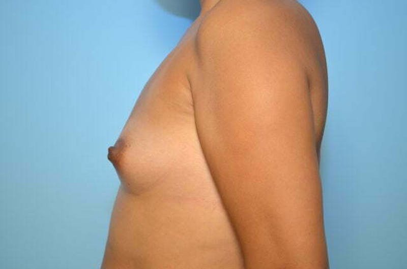 Breast Augmentation Before & After Gallery - Patient 332697 - Image 9