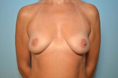 Breast Augmentation Before & After Gallery - Patient 415484 - Image 1