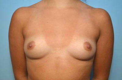 Breast Augmentation Before & After Gallery - Patient 185560 - Image 1