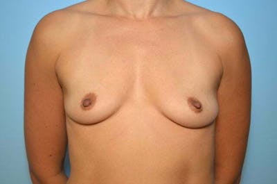 Breast Augmentation Before & After Gallery - Patient 343814 - Image 1