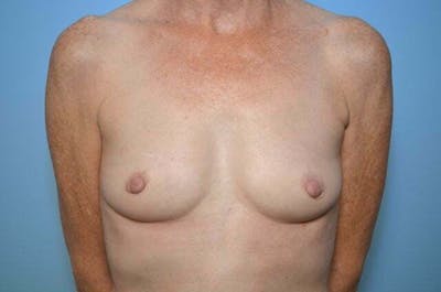 Breast Augmentation Before & After Gallery - Patient 223620 - Image 1