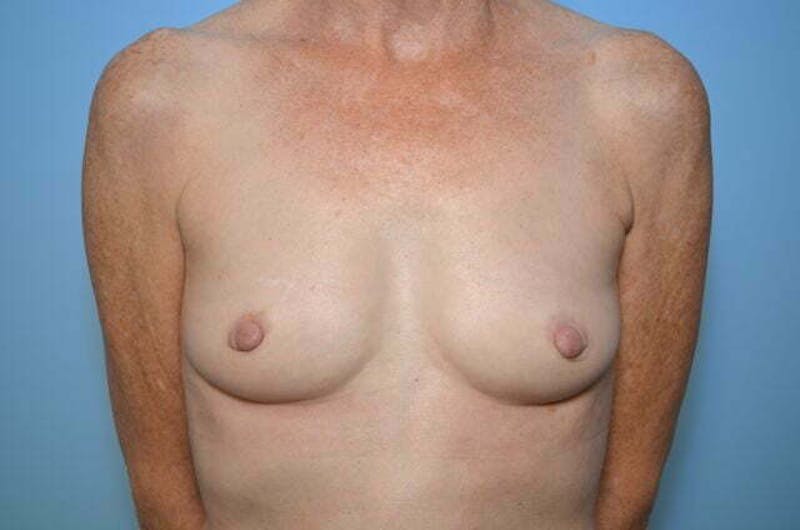Breast Augmentation Before & After Gallery - Patient 223620 - Image 1