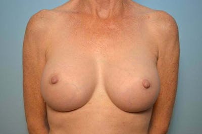 Breast Augmentation Before & After Gallery - Patient 223620 - Image 2